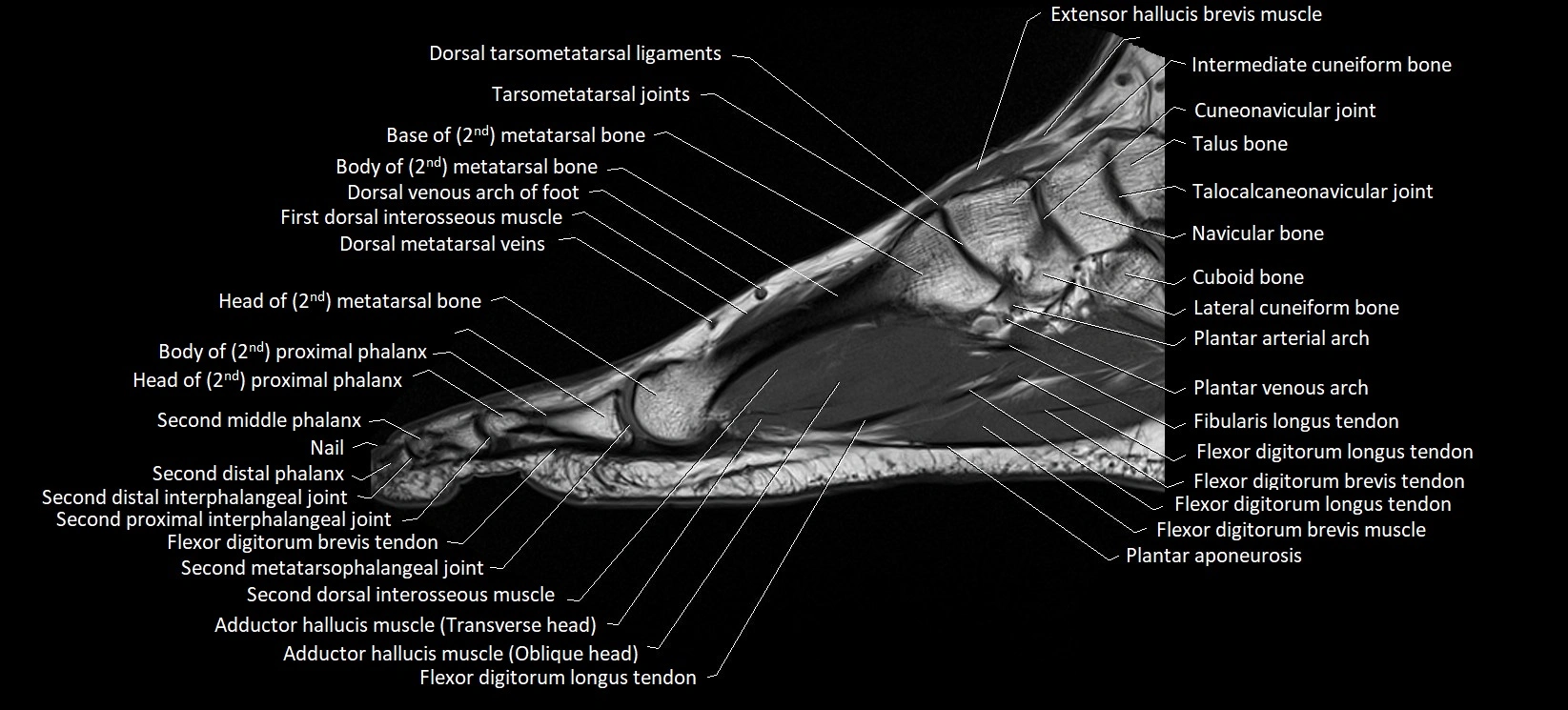 MRI foot sagittal labelled cross sectional anatomy image  12.webp